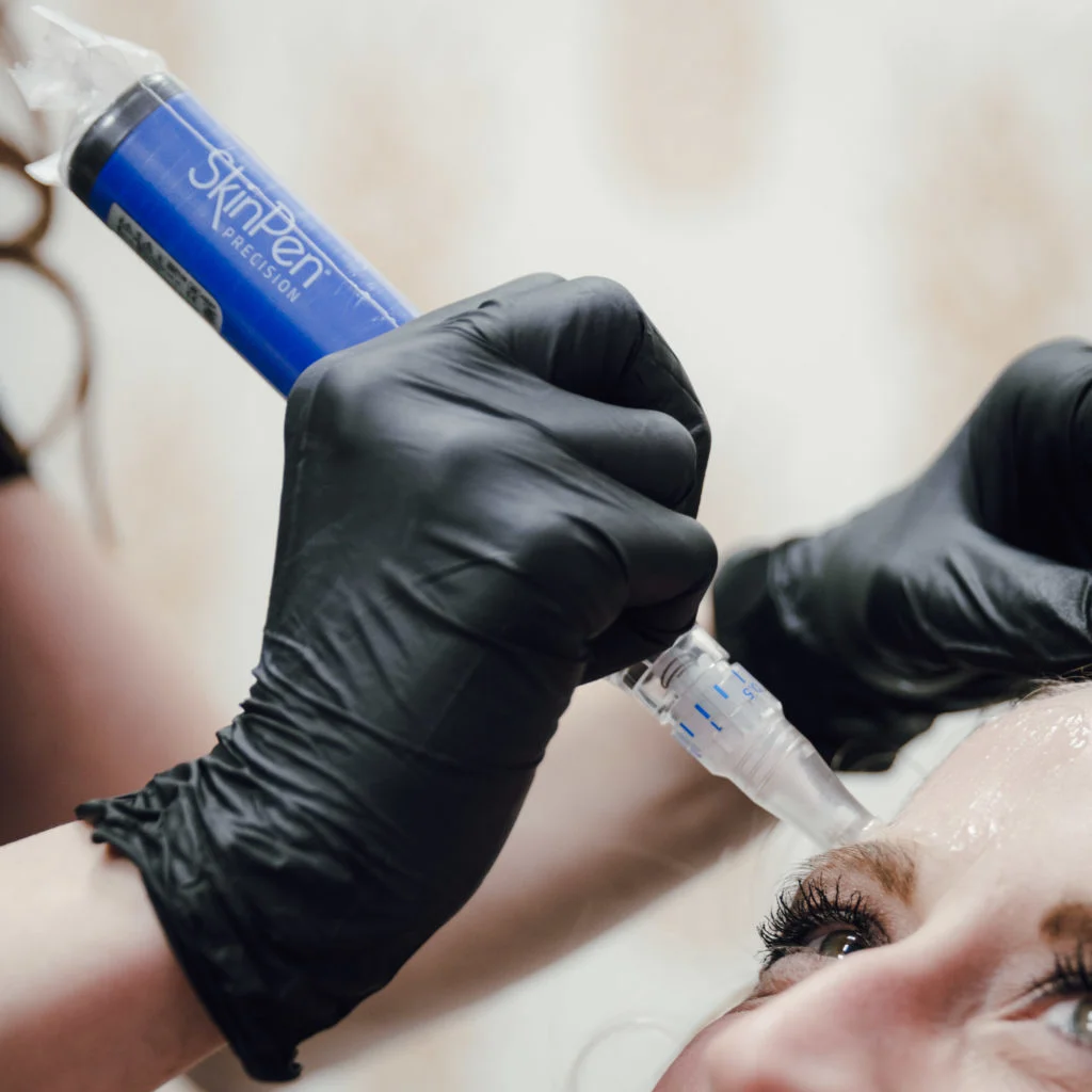 Microneedling | Mclean VA | Dermaglow Med Spa