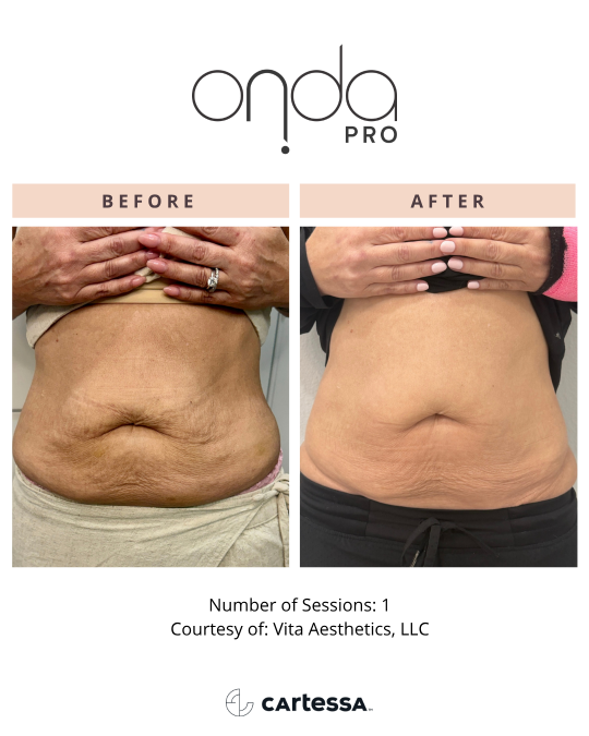 Onda-Pro-Before-After-Abdomen