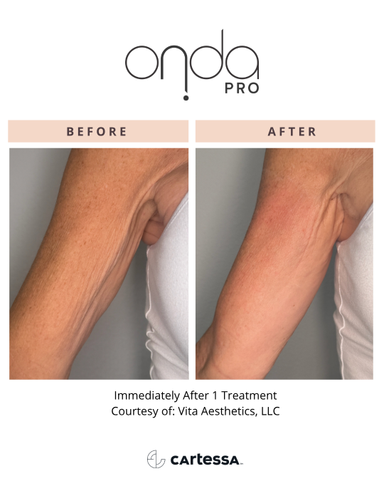 Onda-Pro-Before-After-Arm-1