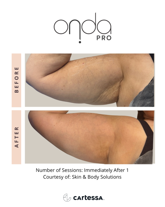 Onda-Pro-Before-After-Arm-2