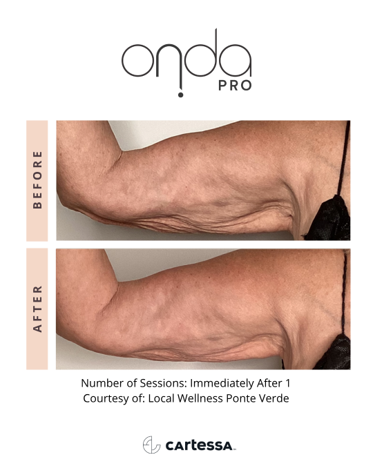 Onda-Pro-Before-After-Arm-3